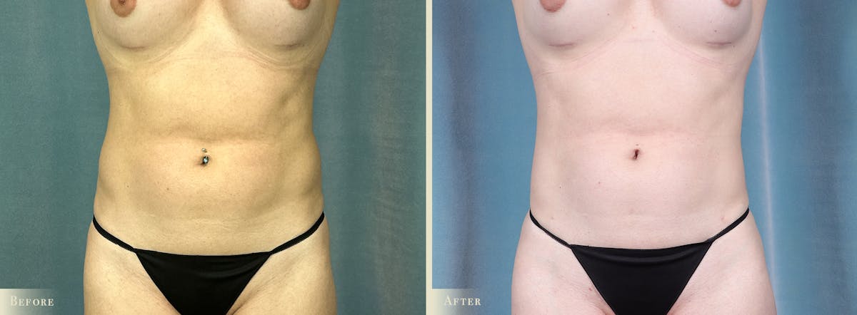 Female Liposuction Before & After Gallery - Patient 293023 - Image 1