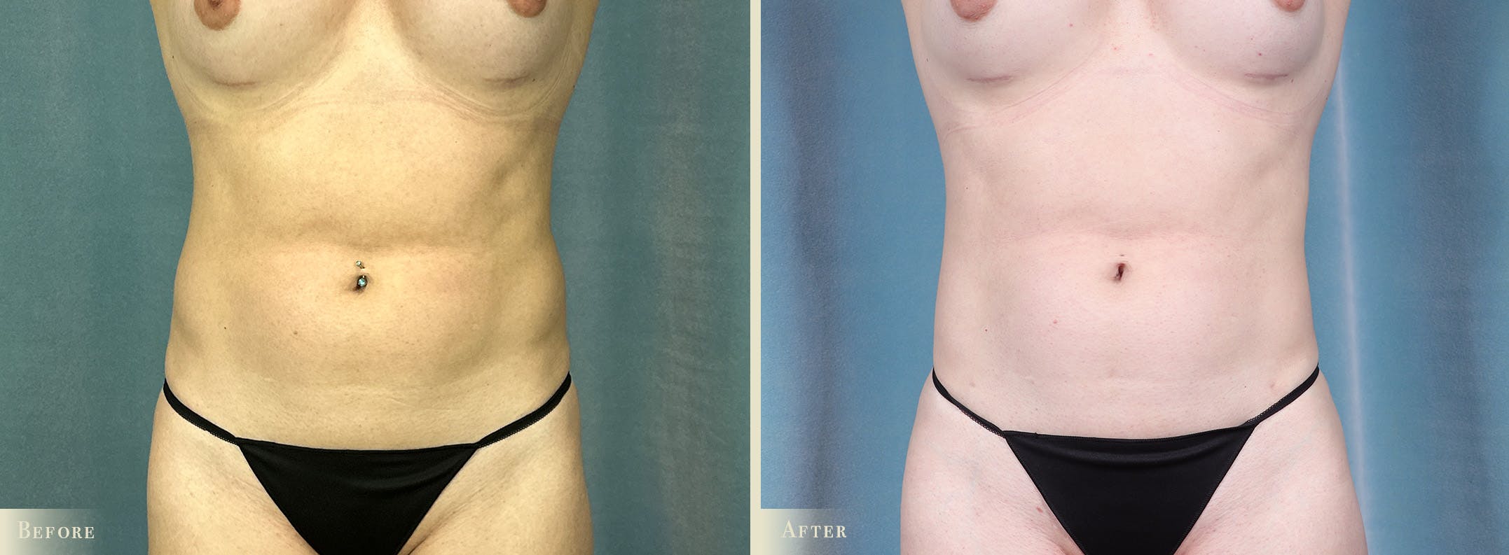 Female Liposuction Before & After Gallery - Patient 293023 - Image 1