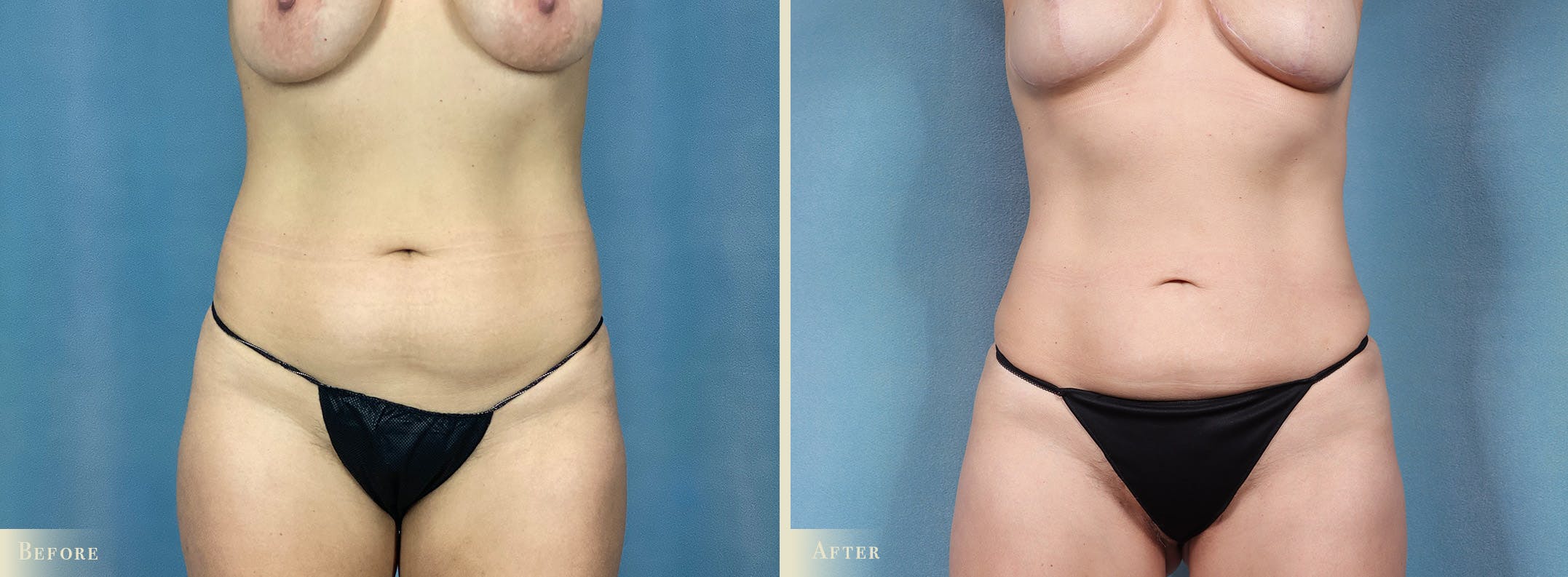 Female Liposuction Before & After Gallery - Patient 325824 - Image 1