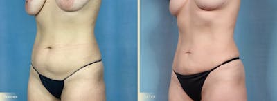 Female Liposuction Before & After Gallery - Patient 325824 - Image 2