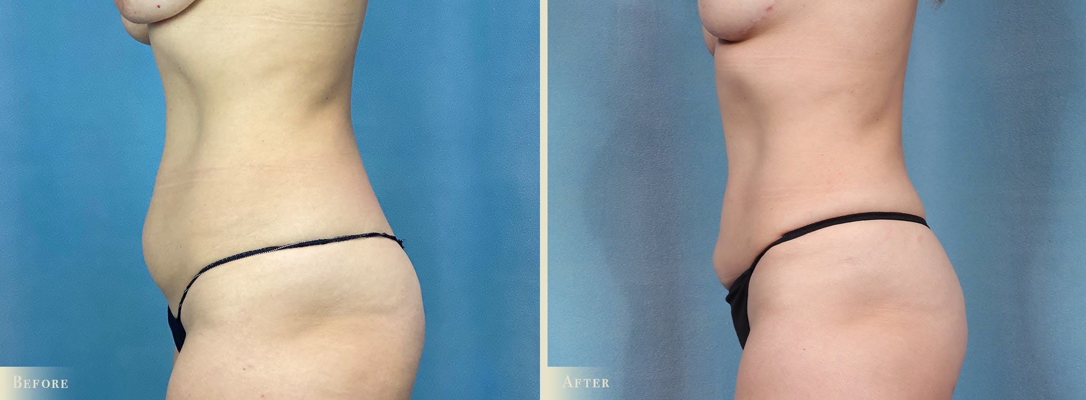 Female Liposuction Before & After Gallery - Patient 325824 - Image 3