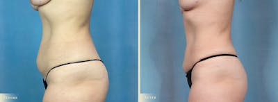 Female Liposuction Before & After Gallery - Patient 325824 - Image 3