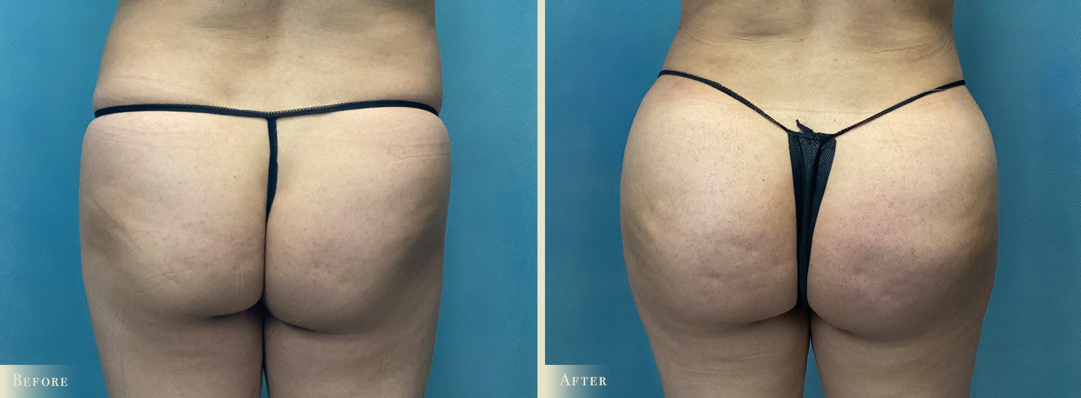 Brazilian Butt Lift Before & After Gallery - Patient 397886 - Image 1