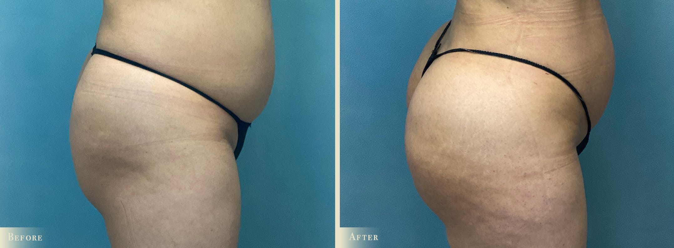 Brazilian Butt Lift Before & After Gallery - Patient 397886 - Image 2