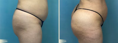 Brazilian Butt Lift Before & After Gallery - Patient 397886 - Image 2