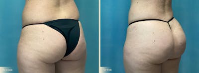 Brazilian Butt Lift Before & After Gallery - Patient 213063 - Image 2