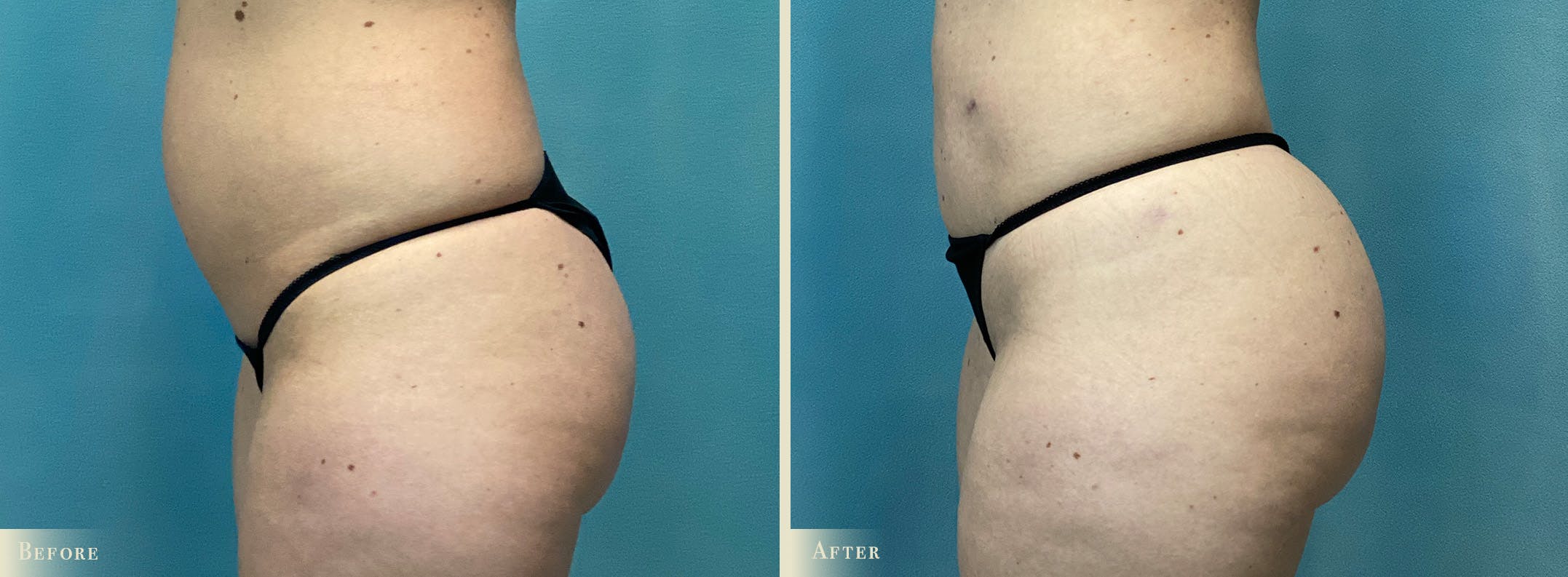 Brazilian Butt Lift Before & After Gallery - Patient 213063 - Image 3