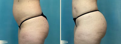 Brazilian Butt Lift Before & After Gallery - Patient 213063 - Image 3