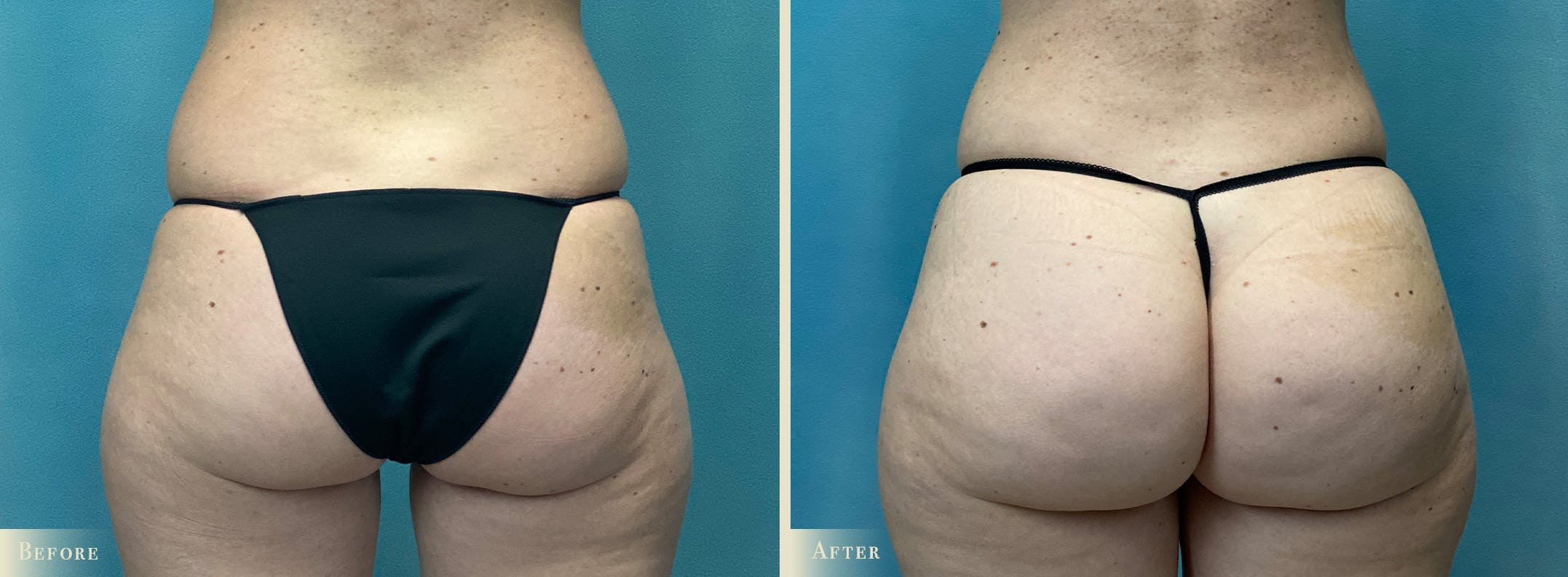 Brazilian Butt Lift Before & After Gallery - Patient 213063 - Image 1