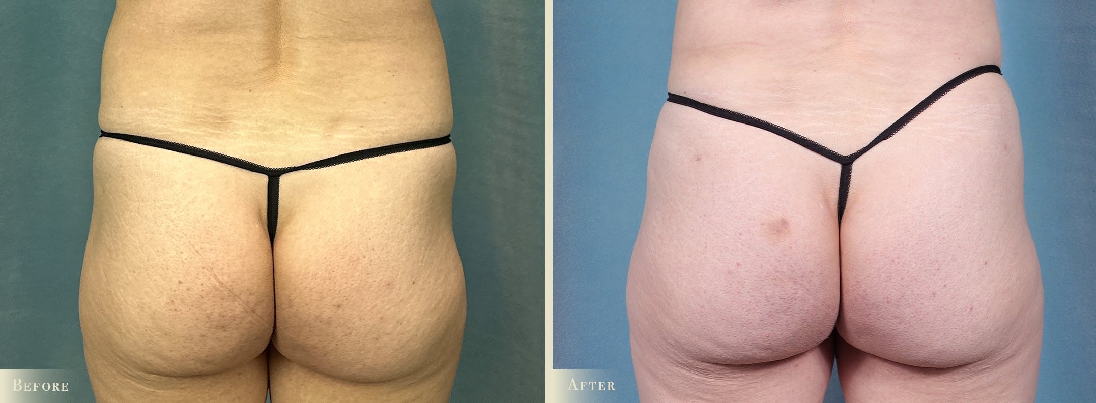 Brazilian Butt Lift Before & After Gallery - Patient 111224 - Image 1