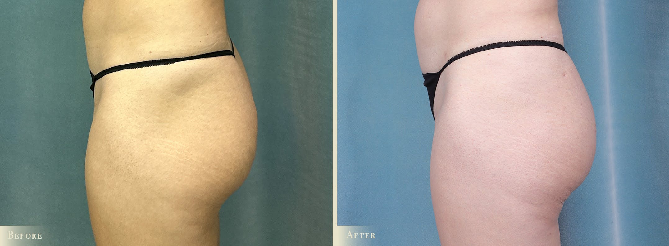 Brazilian Butt Lift Before & After Gallery - Patient 111224 - Image 2