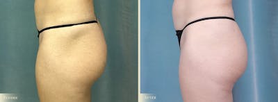 Brazilian Butt Lift Before & After Gallery - Patient 111224 - Image 2