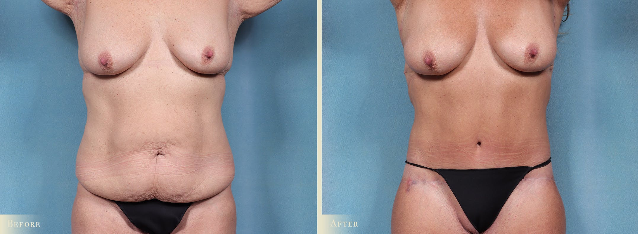 Body Lift Before & After Gallery - Patient 106276 - Image 1