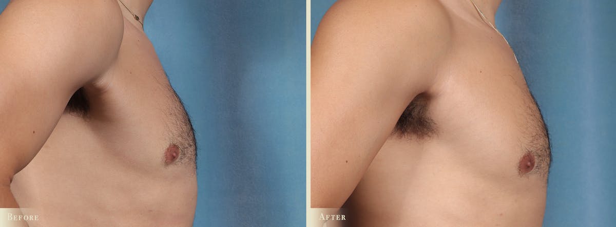Male Breast Reduction (Gynecomastia) Before & After Gallery - Patient 101135 - Image 3