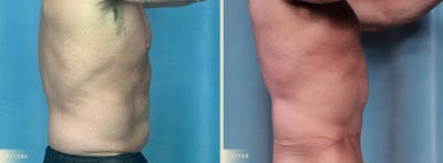 Tummy Tuck Before & After Gallery - Patient 423154 - Image 2