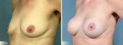 Breast Augmentation Before & After Gallery - Patient 116112 - Image 2