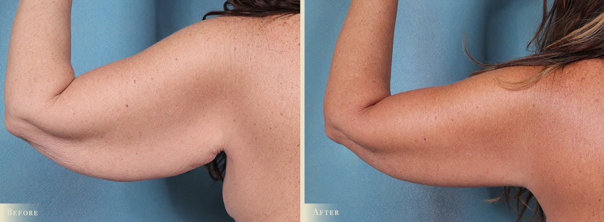 Arm Lift Before & After Gallery - Patient 891604 - Image 1