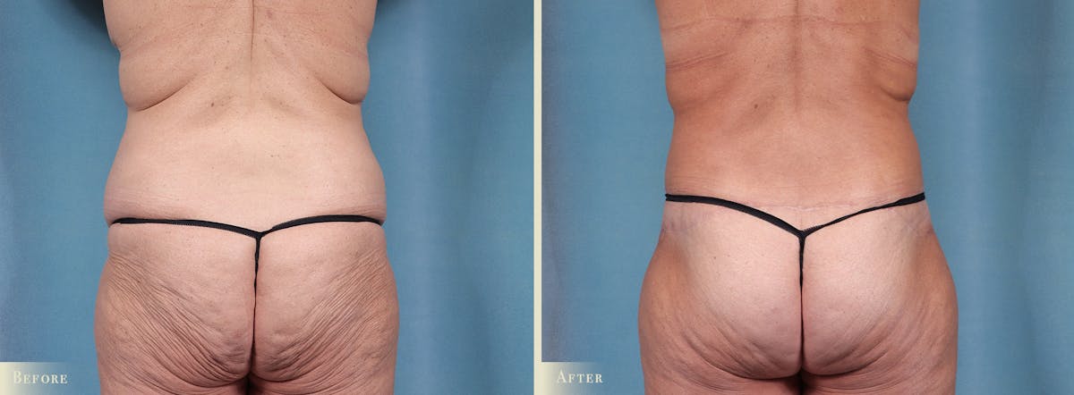 Weight Loss Body Contouring Combination Procedures Before & After Gallery - Patient 300614 - Image 3