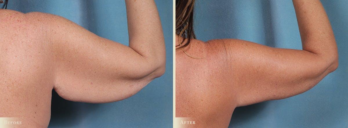 Weight Loss Body Contouring Combination Procedures Before & After Gallery - Patient 300614 - Image 7