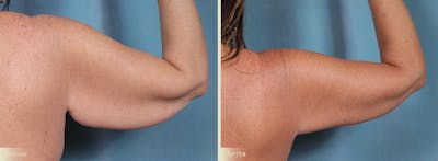 Weight Loss Body Contouring Combination Procedures Before & After Gallery - Patient 300614 - Image 7