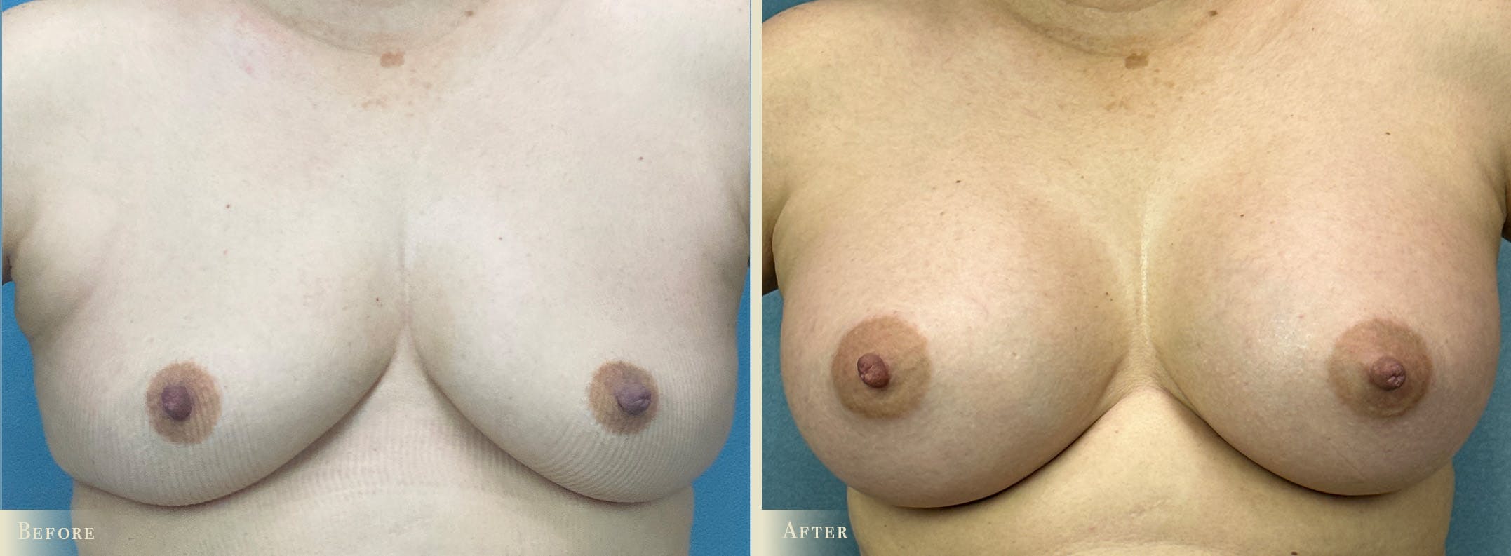 Breast Augmentation Before & After Gallery - Patient 110276 - Image 1