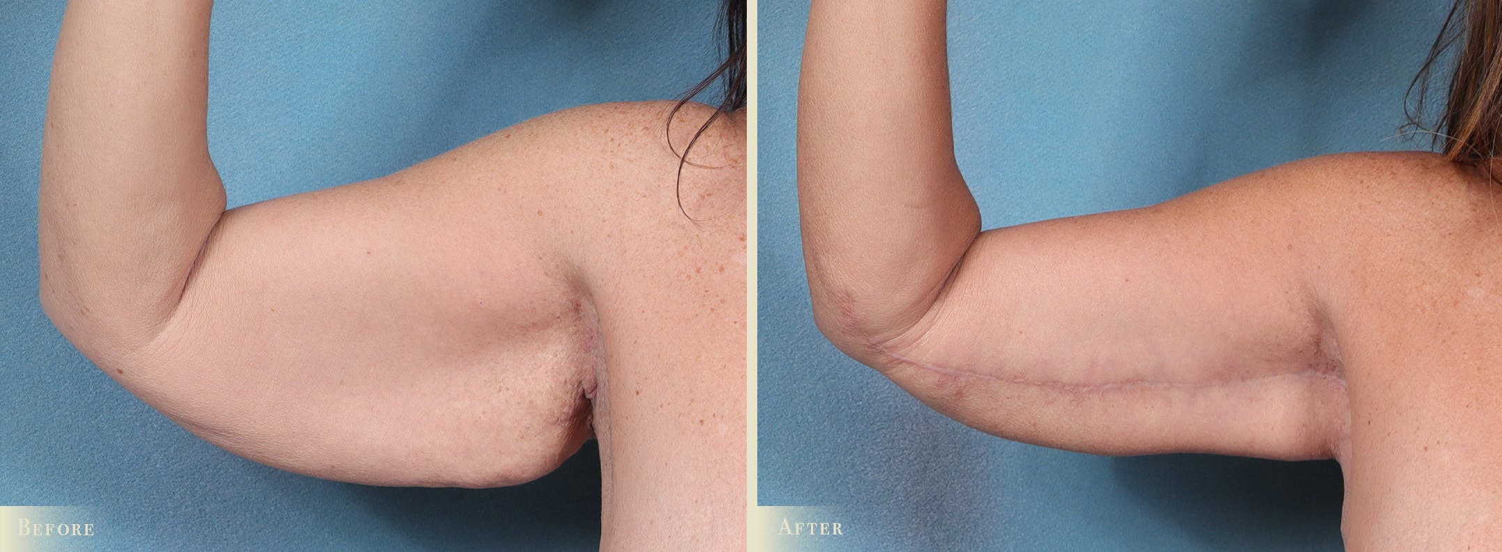 Arm Lift Before & After Gallery - Patient 891604 - Image 2
