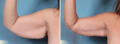 Arm Lift Before & After Gallery - Patient 891604 - Image 2