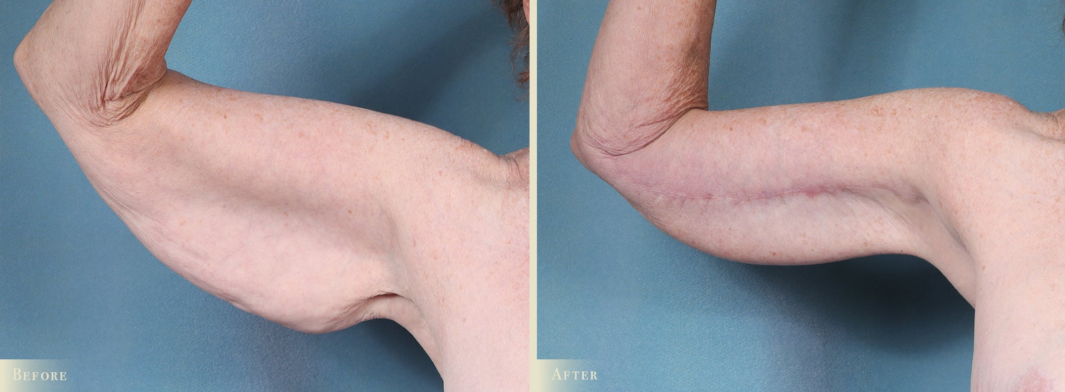 Arm Lift Before & After Gallery - Patient 149710 - Image 4