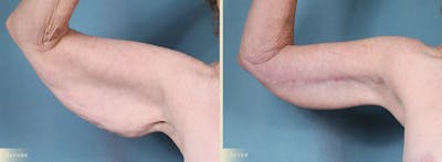 Arm Lift Before & After Gallery - Patient 149710 - Image 4