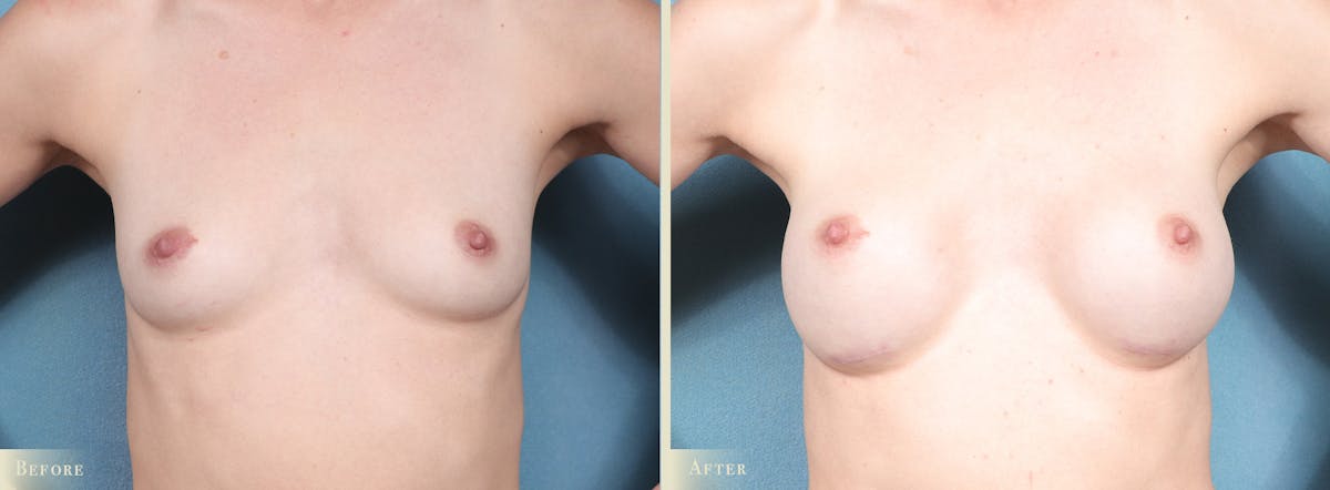 Breast Augmentation Before & After Gallery - Patient 164688 - Image 1