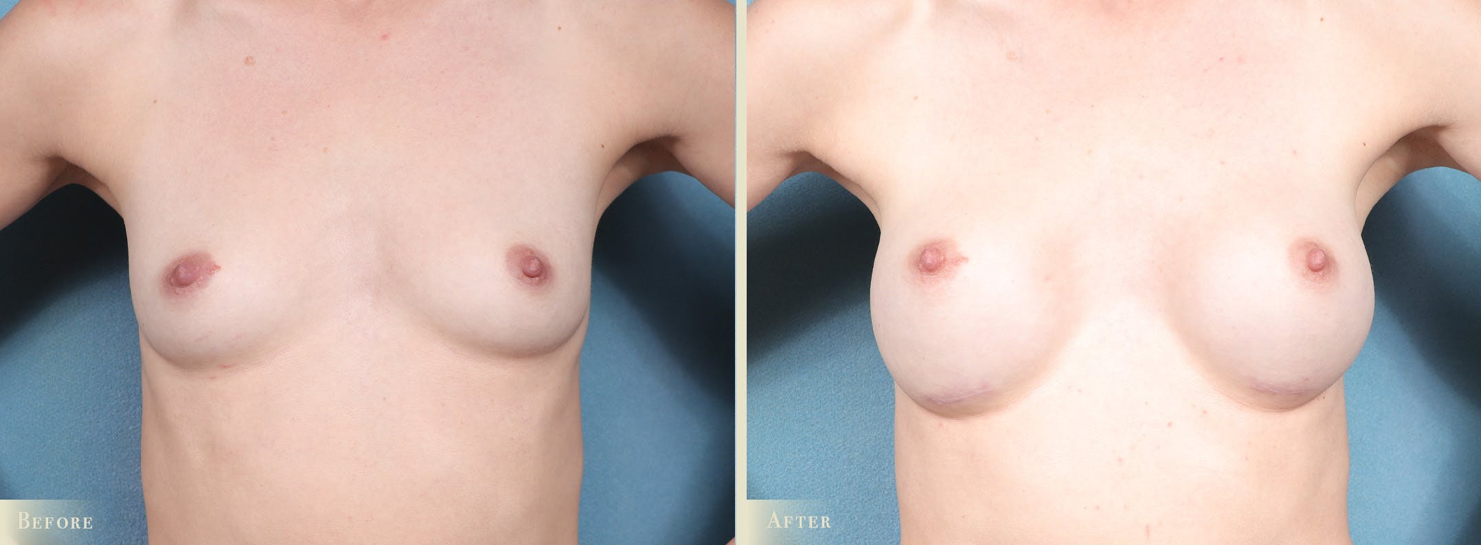 Breast Augmentation Before & After Gallery - Patient 164688 - Image 1
