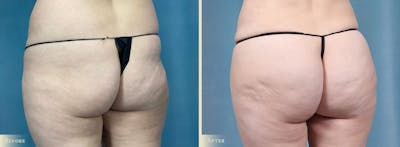 Brazilian Butt Lift Before & After Gallery - Patient 331180 - Image 2