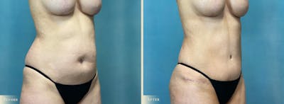 Brazilian Butt Lift Before & After Gallery - Patient 659667 - Image 4