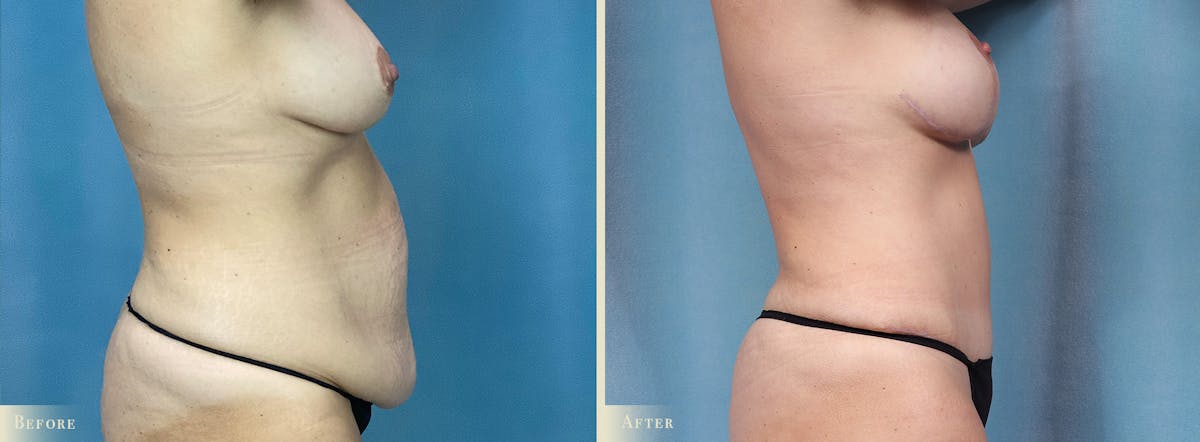 Tummy Tuck Before & After Gallery - Patient 505872 - Image 2