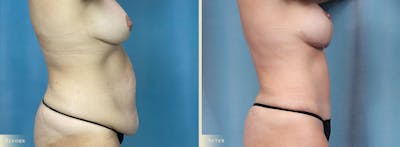 Tummy Tuck Before & After Gallery - Patient 505872 - Image 2