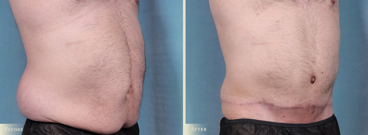 Male Tummy Tuck Before & After Gallery - Patient 159841 - Image 2