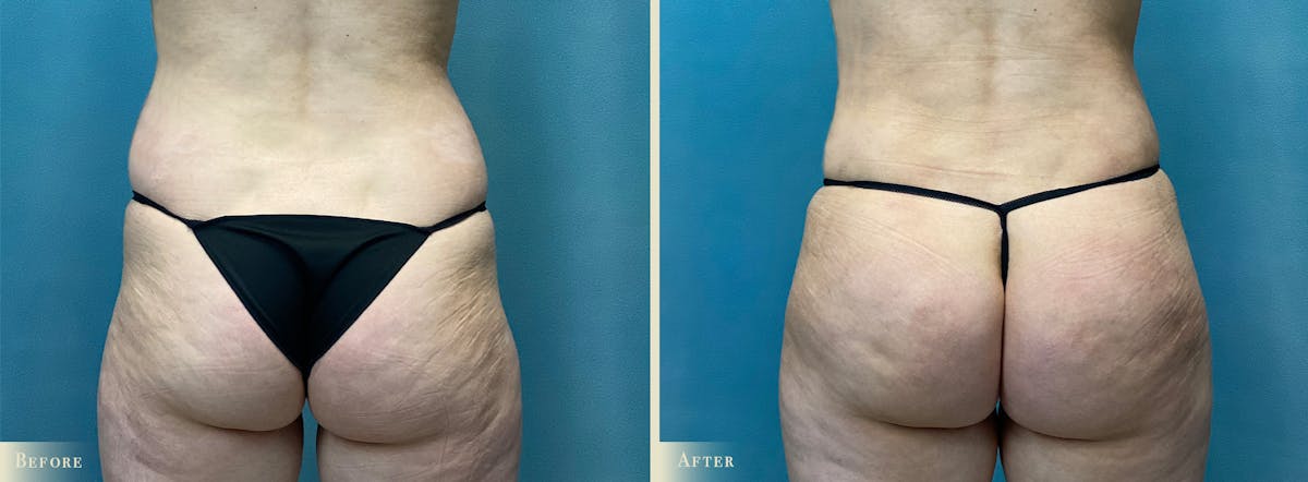 Brazilian Butt Lift Before & After Gallery - Patient 659667 - Image 1