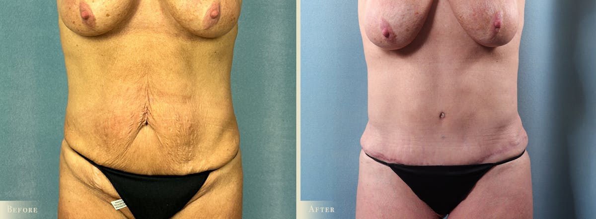 Tummy Tuck Before & After Gallery - Patient 417453 - Image 1