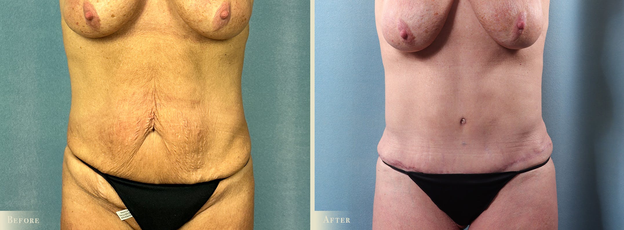 Tummy Tuck Before & After Gallery - Patient 417453 - Image 1
