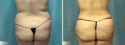 Brazilian Butt Lift Before & After Gallery - Patient 171114 - Image 1