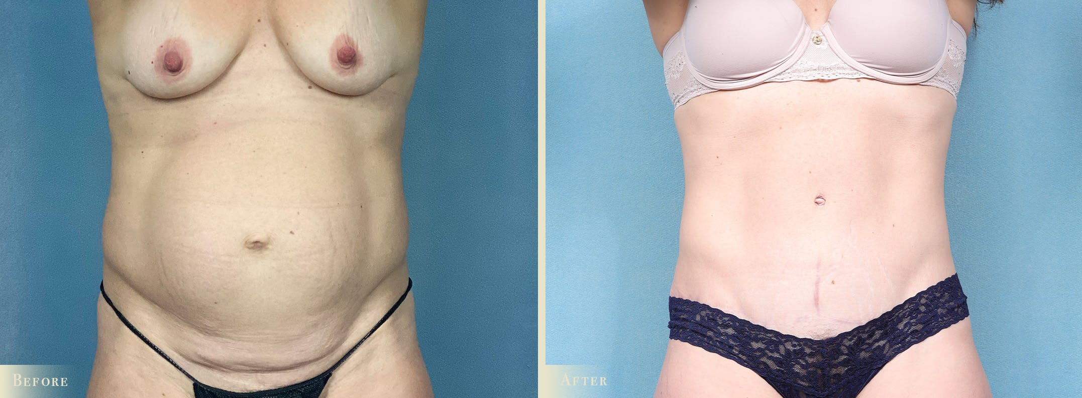 Tummy Tuck Before & After Gallery - Patient 700488 - Image 1