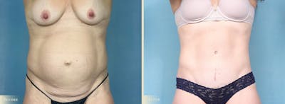 Tummy Tuck Before & After Gallery - Patient 700488 - Image 1