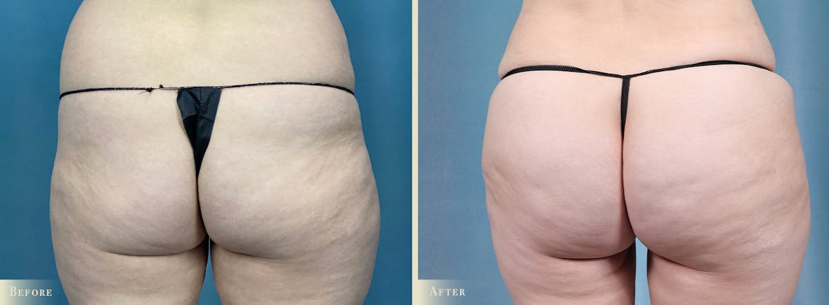 Brazilian Butt Lift Before & After Gallery - Patient 331180 - Image 1