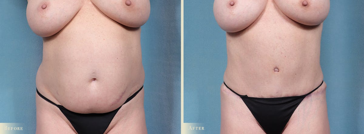 Tummy Tuck Before & After Gallery - Patient 754046 - Image 1