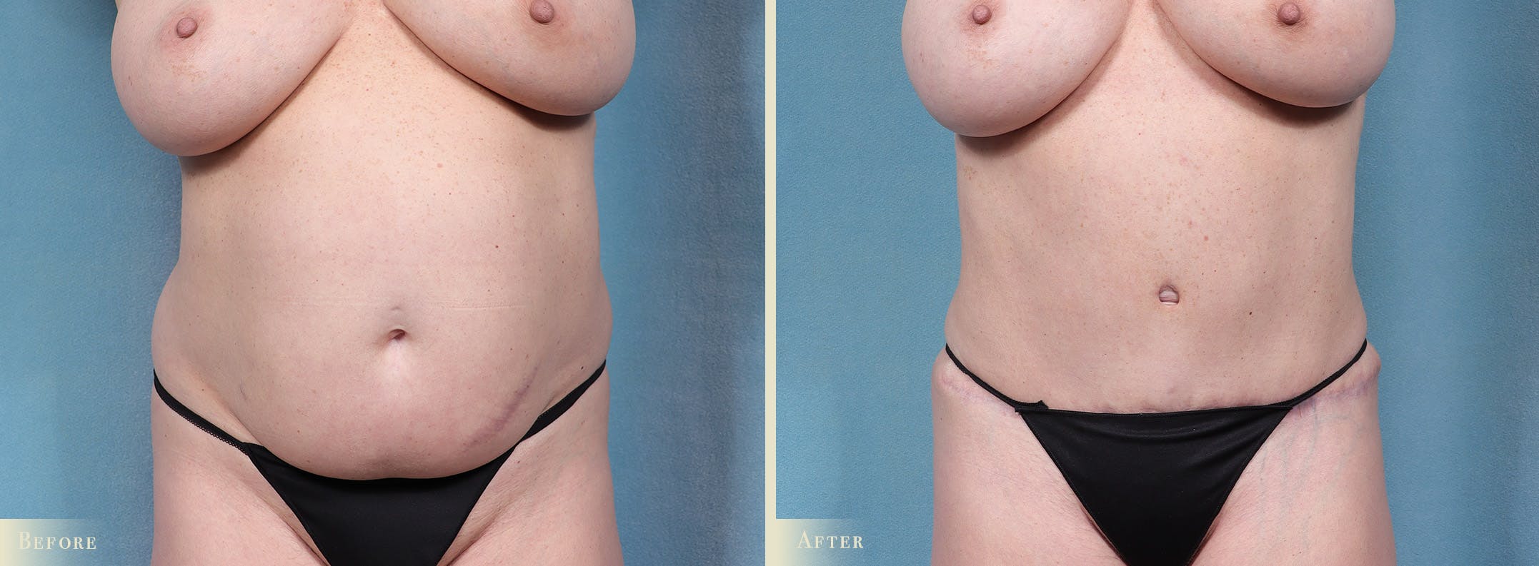 Tummy Tuck Before & After Gallery - Patient 754046 - Image 1