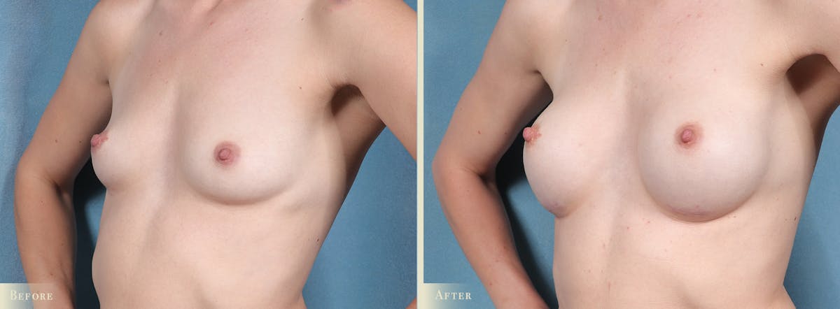 Breast Augmentation Before & After Gallery - Patient 164688 - Image 2