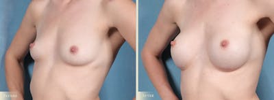 Breast Augmentation Before & After Gallery - Patient 164688 - Image 2