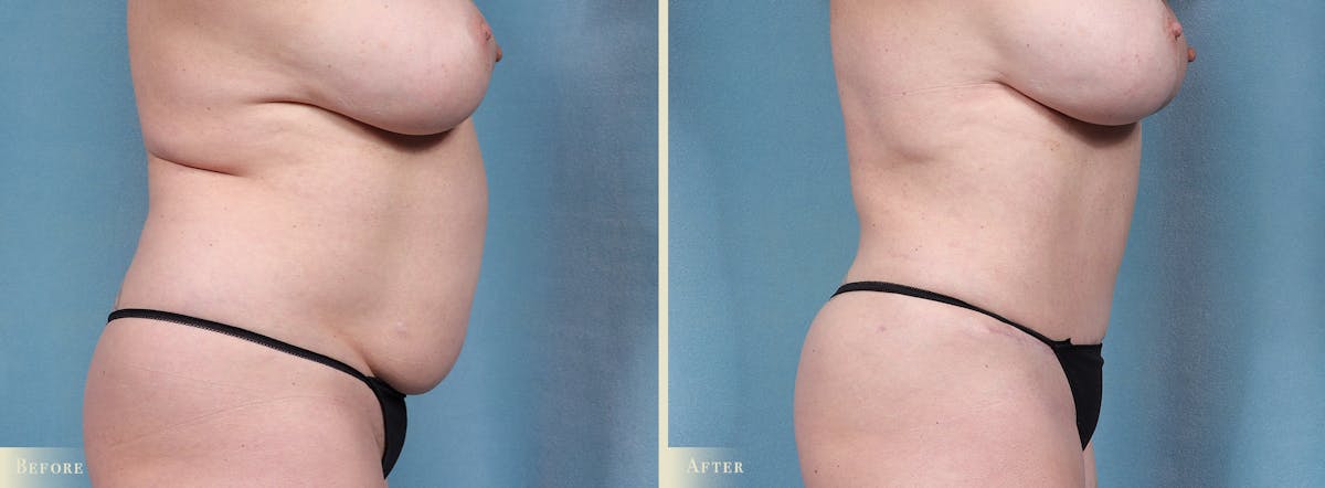 Tummy Tuck Before & After Gallery - Patient 754046 - Image 3