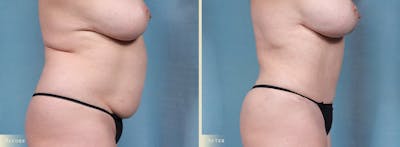 Tummy Tuck Before & After Gallery - Patient 754046 - Image 3
