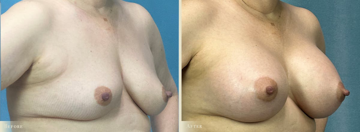 Breast Augmentation Before & After Gallery - Patient 110276 - Image 2